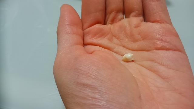 歯の抜ける原因第一位は・・・・・・