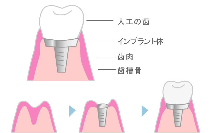 インプラント治療例①